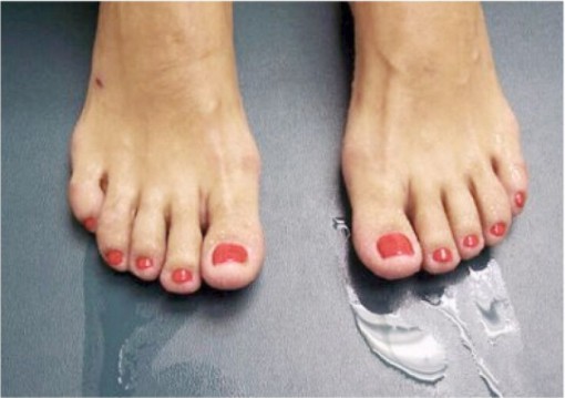 Fit Feet Podiatrists Larne Hyperhidrosis