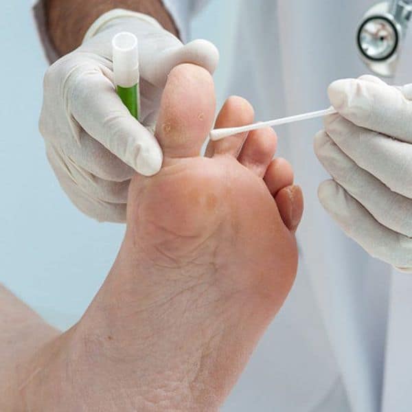 Fit Feet Podiatrists Larne Northern Ireland Surgical Verruca Removal 600x